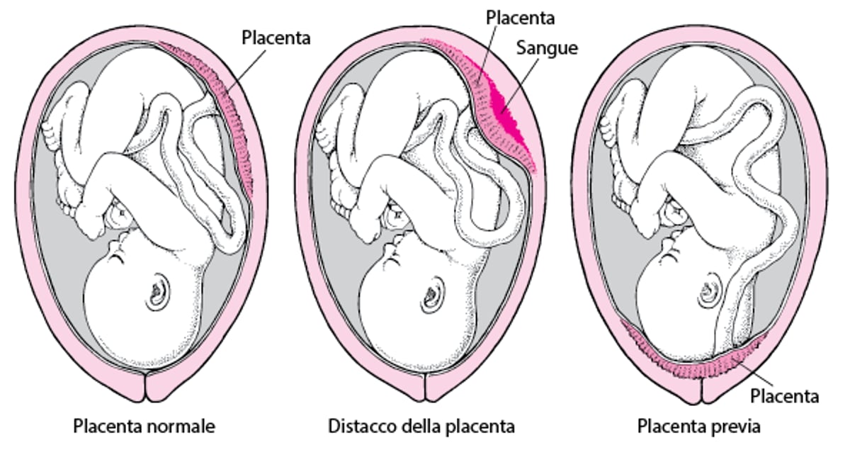 Problemi legati alla placenta