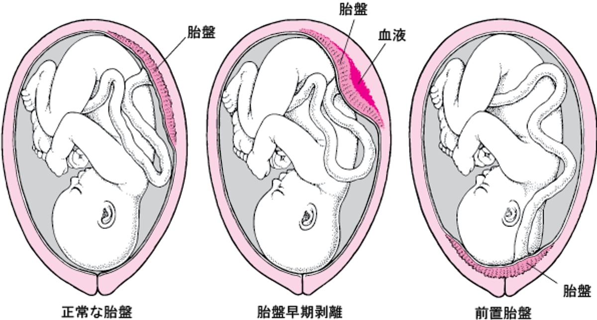 胎盤の問題