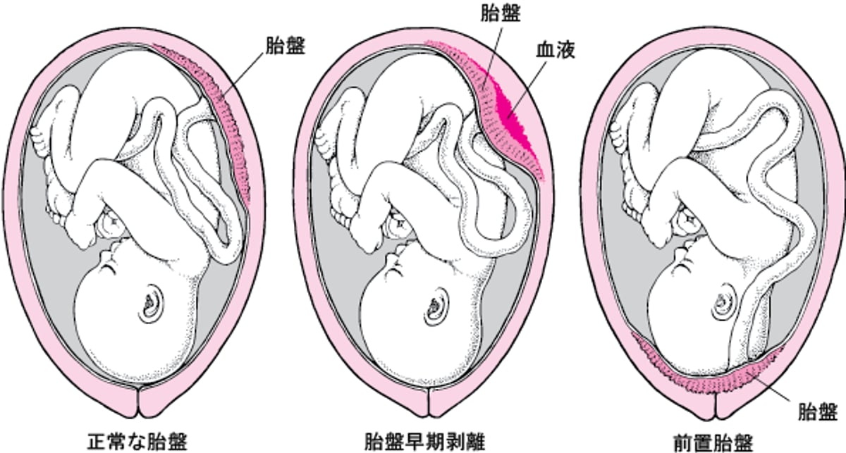 胎盤たいばんの問題もんだい