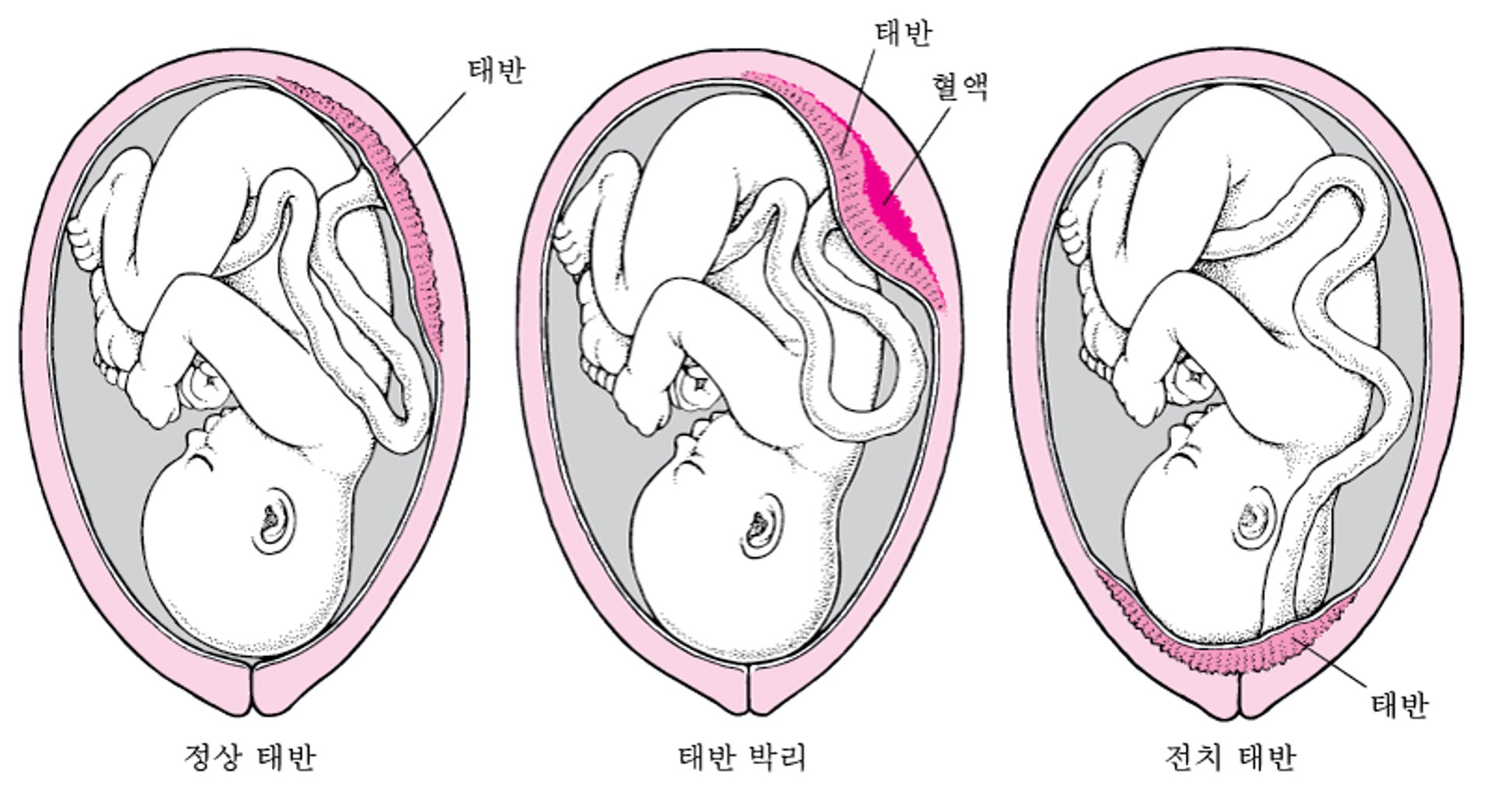 태반 문제