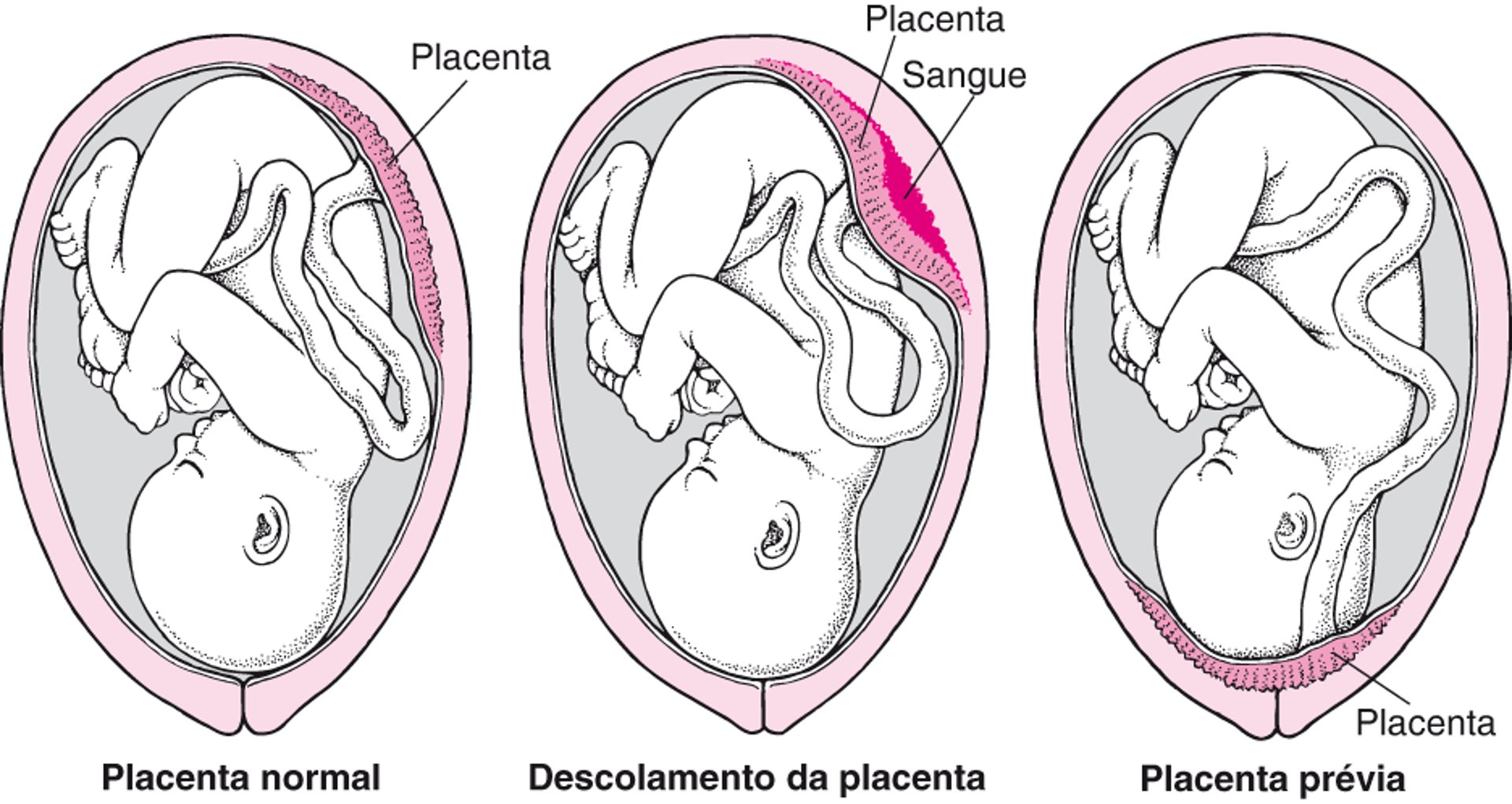 Problemas com a placenta