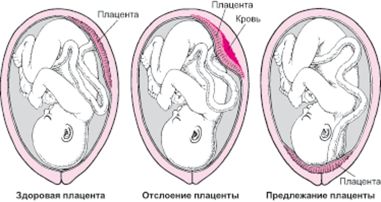 Проблемы с плацентой