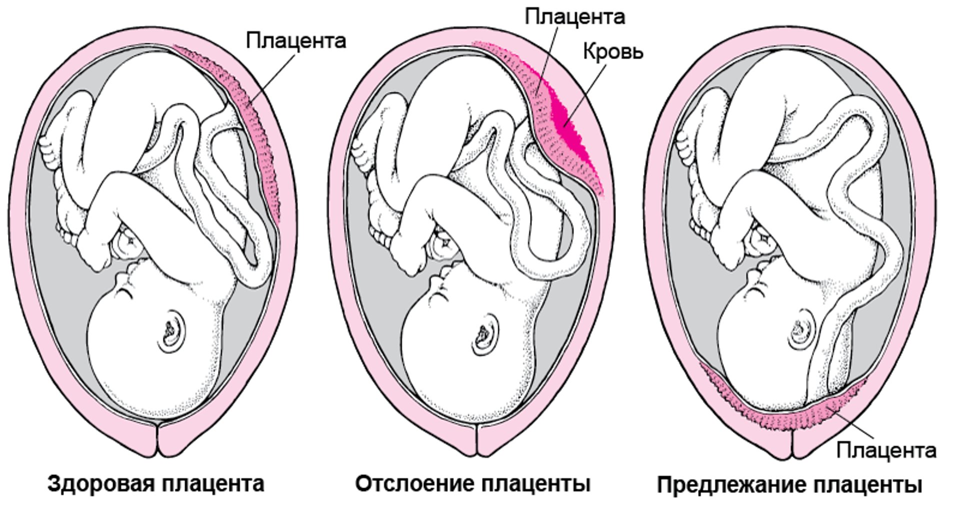 Проблемы с плацентой