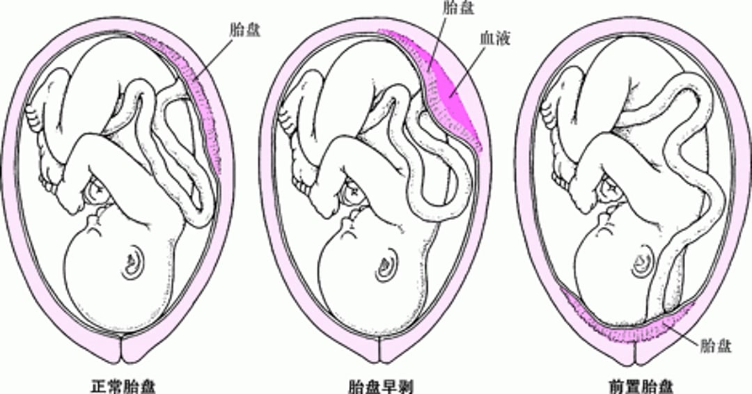 胎盘问题