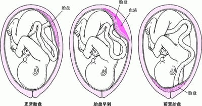 胎盘问题