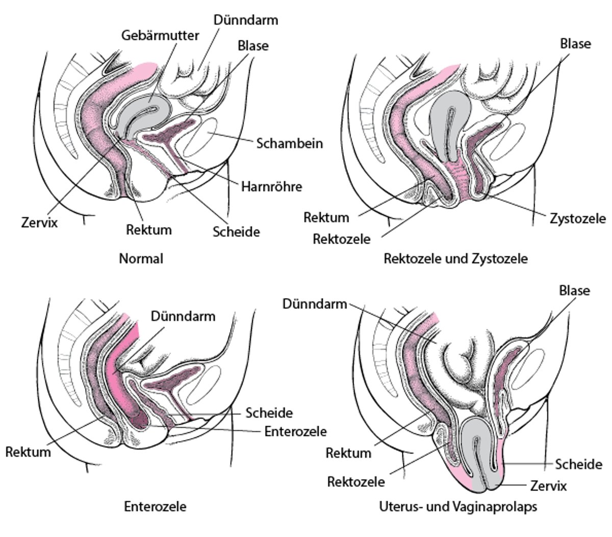 Wenn der Boden einbricht: Prolaps der Beckenorgane