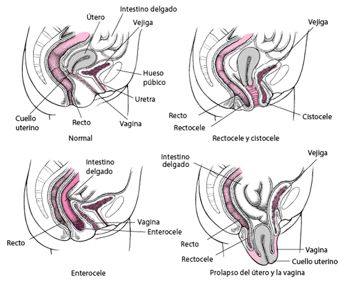 Cuando el fondo se cae: prolapso en la pelvis