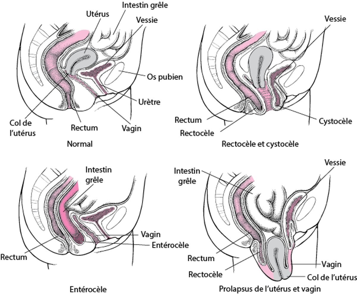Lorsque le plancher s’affaisse : les prolapsus pelviens