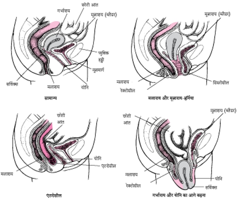 जब नीचे का भाग गिर जाता है: पेल्विस में आगे को बढ़ाव