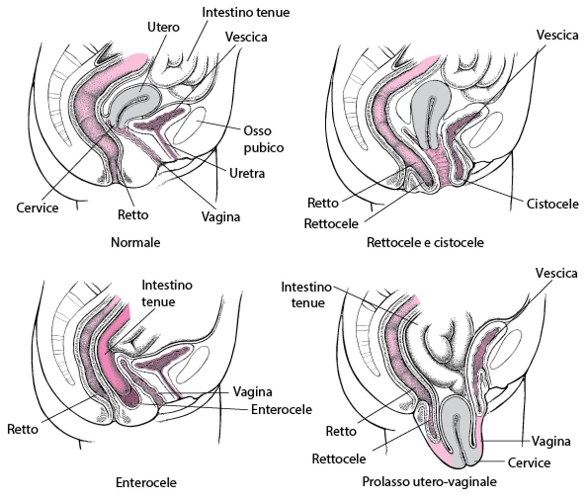 Quando le parti basse fuoriescono: prolasso pelvico