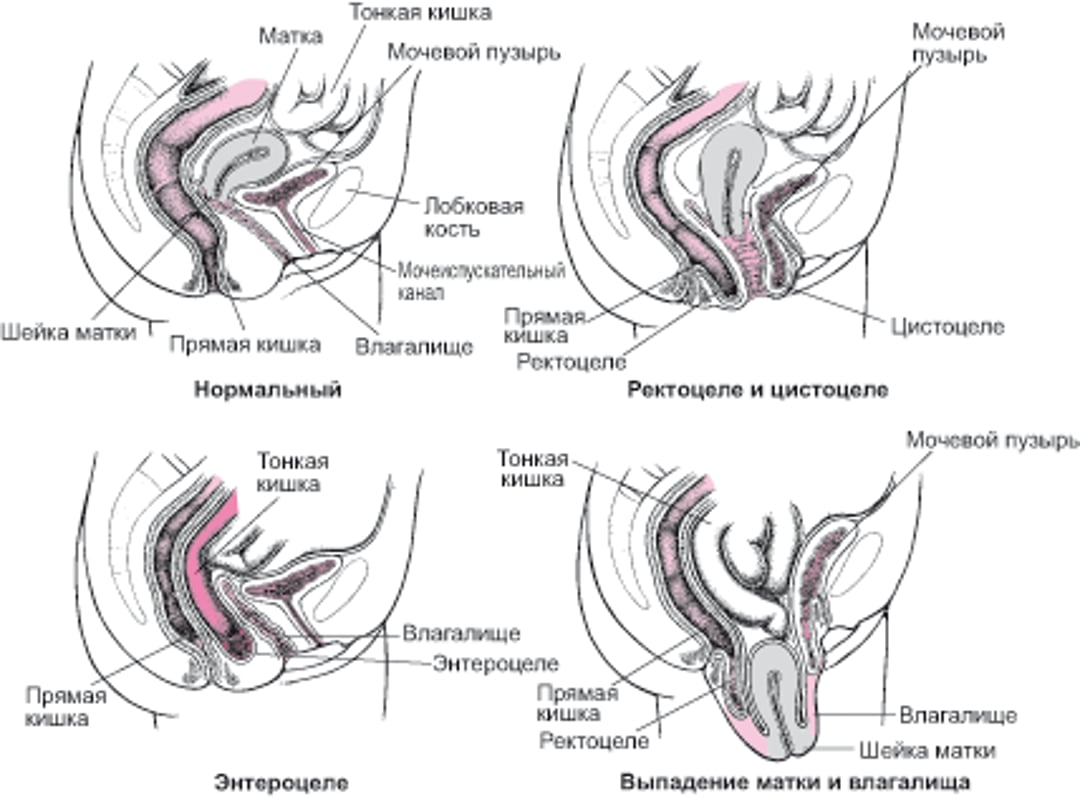 Когда выпадает дно: Пролапс органов малого таза