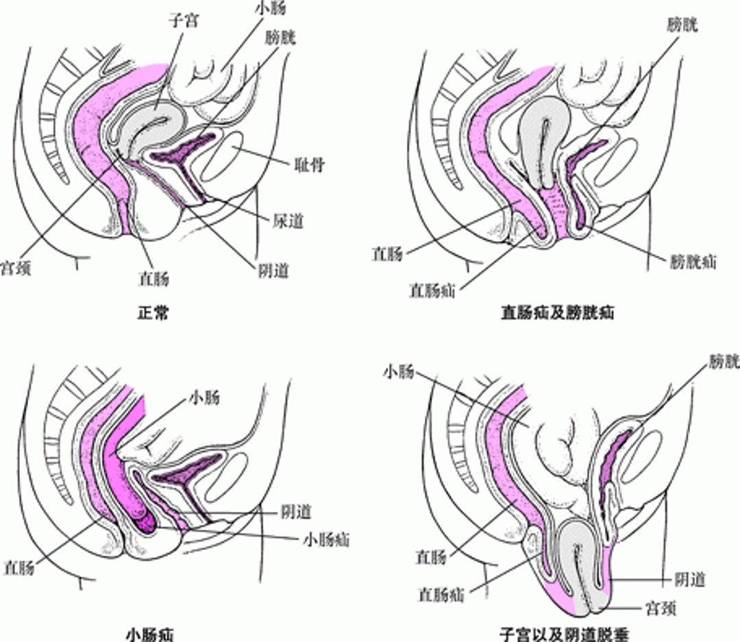 当底部下坠: 骨盆脱垂