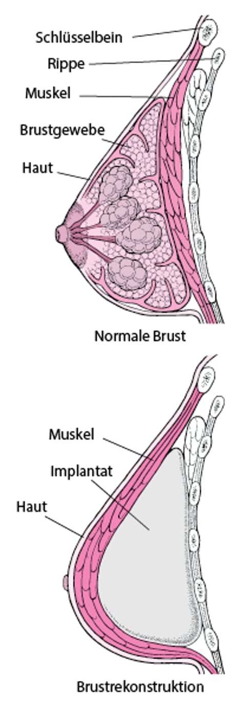 Wiederaufbau der Brust