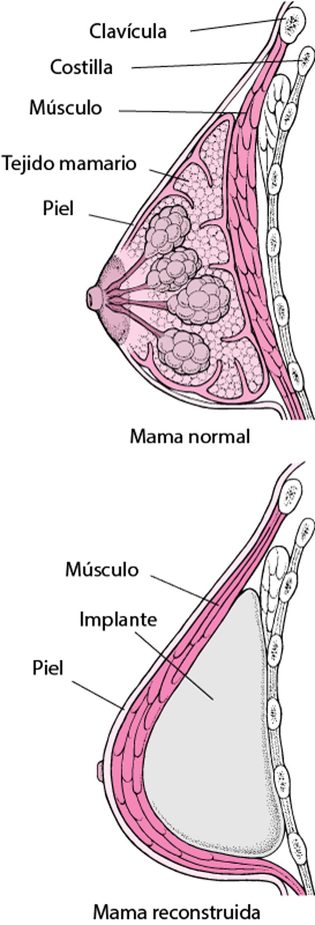 Reconstrucción de la mama