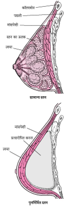 स्तन पुनर्निर्माण