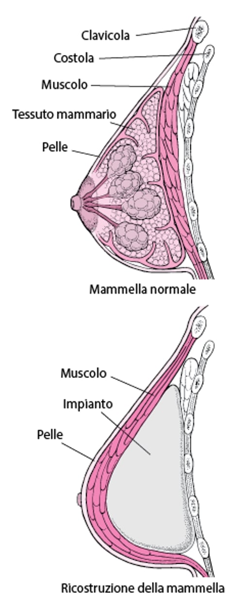 Ricostruzione della mammella