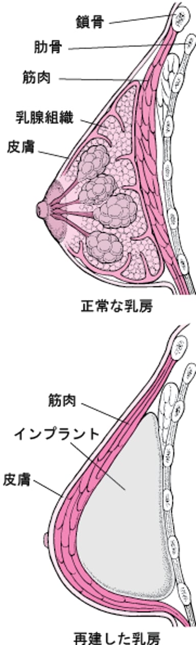 乳房の再建