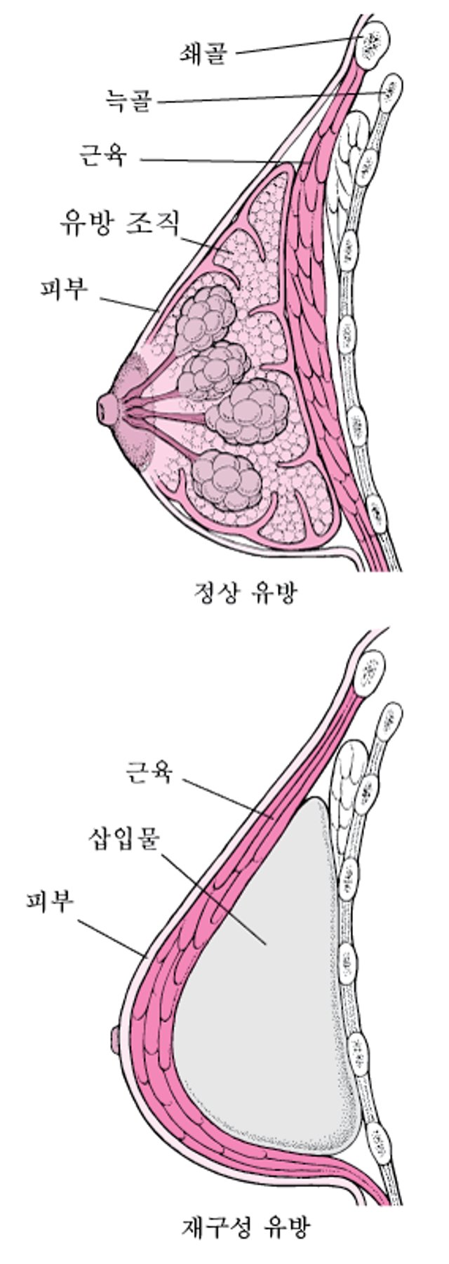 유방 재건