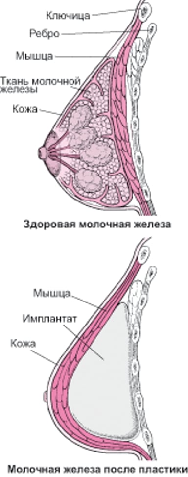 Реконструкция молочной железы