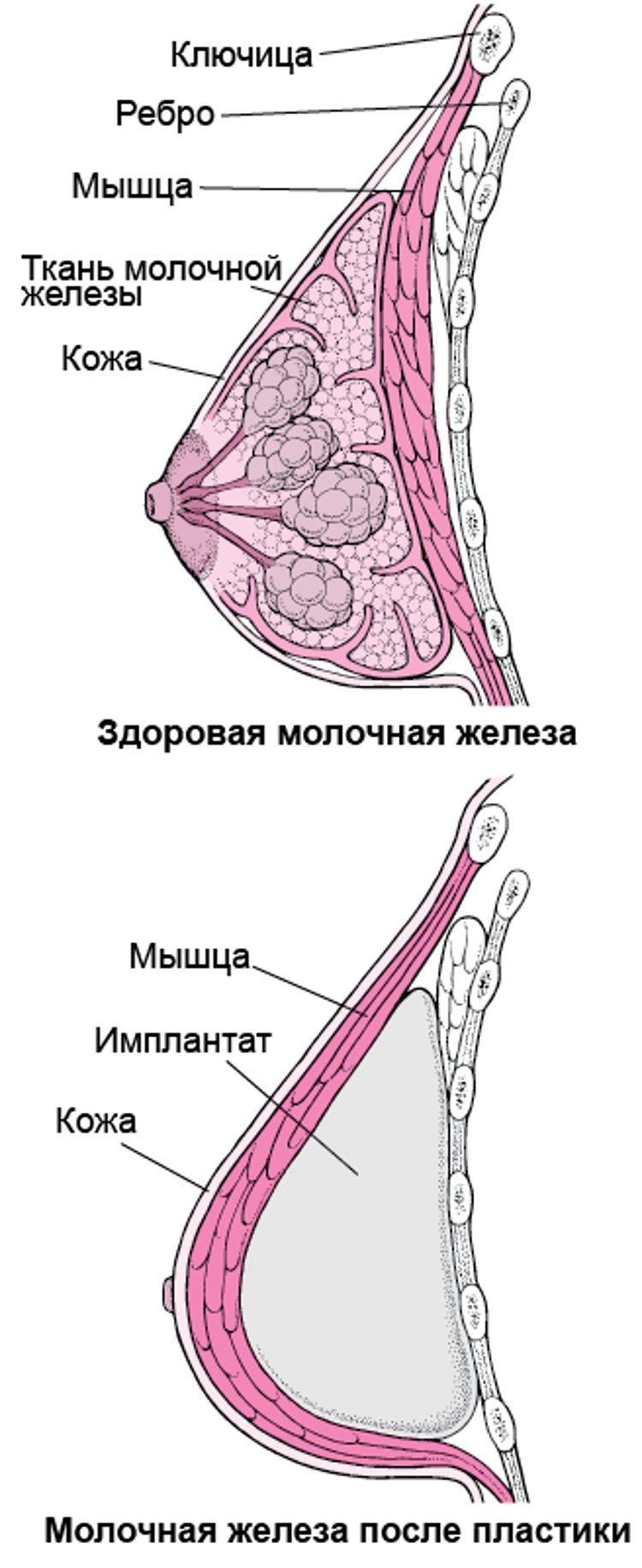 Реконструкция молочной железы