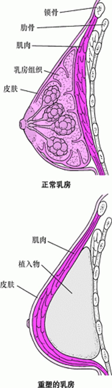 重建乳房