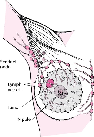 What Is a Sentinel Lymph Node?
