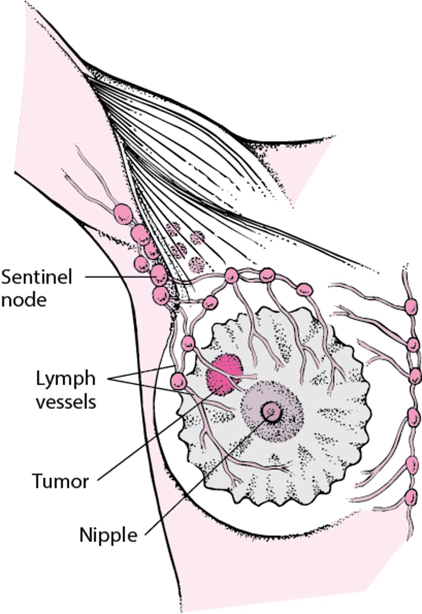 What Is a Sentinel Lymph Node?