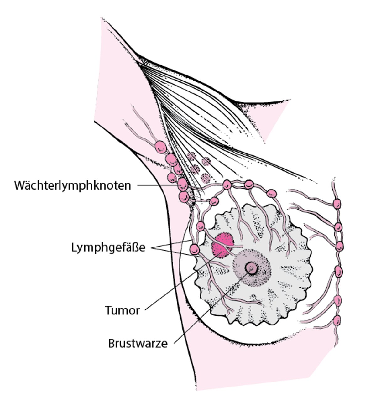 Was ist ein Sentinel-Lymphknoten?