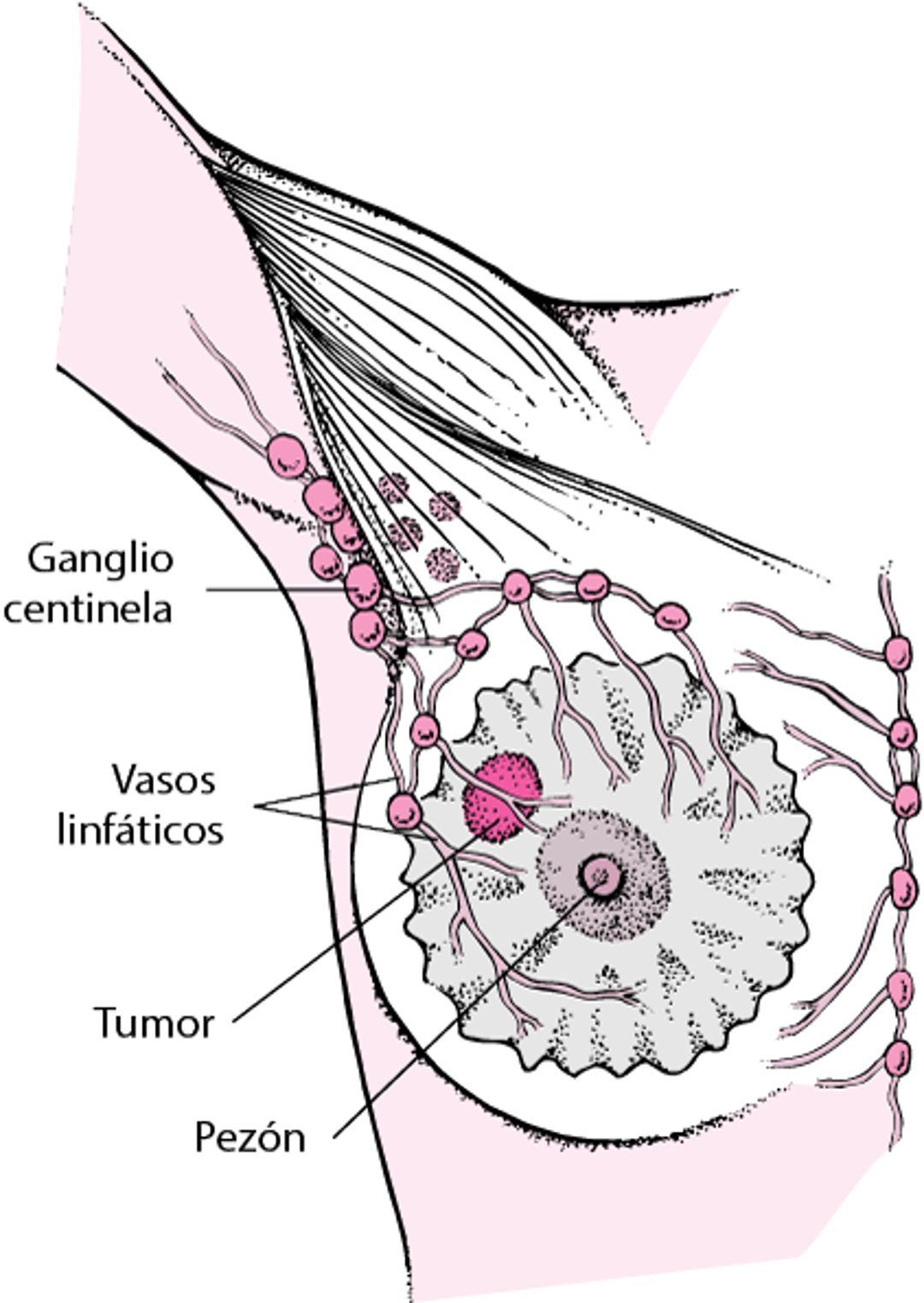 ¿Qué es el ganglio centinela?
