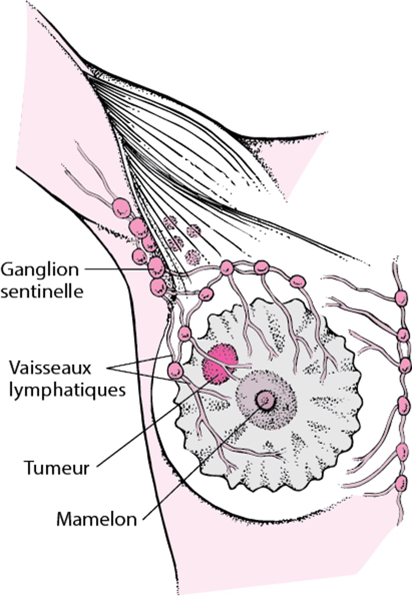 Qu’est-ce qu’un ganglion sentinelle ?