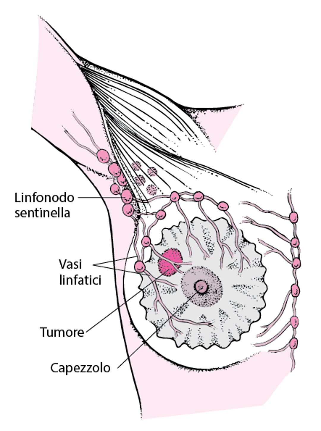 Che cos’è un linfonodo sentinella?