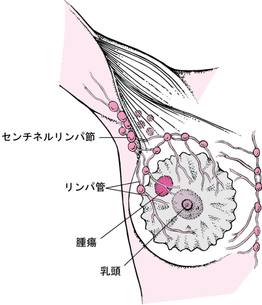 センチネルリンパ節とは