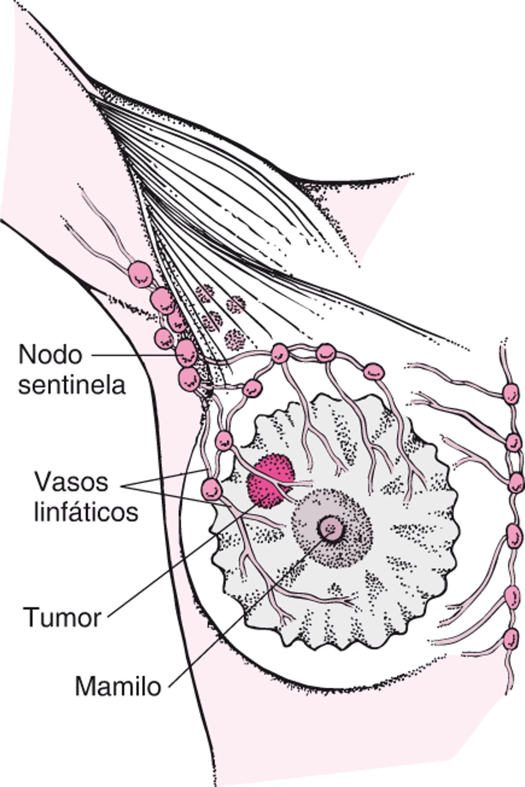 O que é um linfonodo sentinela?