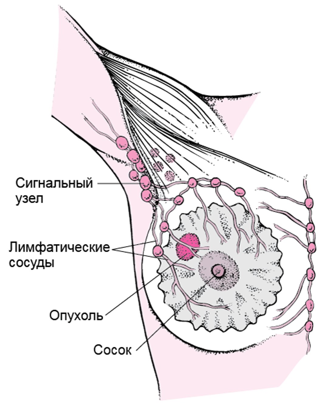 Что такое сигнальный лимфатический узел?