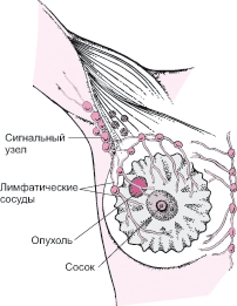 Что такое сигнальный лимфатический узел?