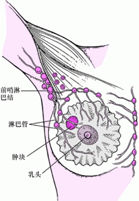 什么是前哨淋巴结