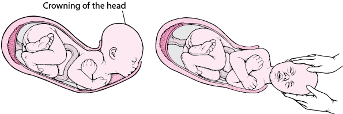 Stages of Labor