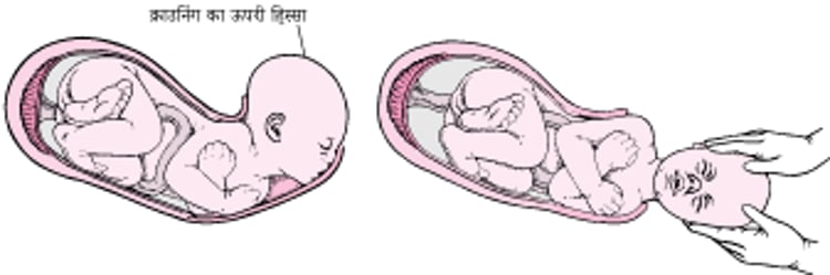 प्रसवपीड़ा के चरण