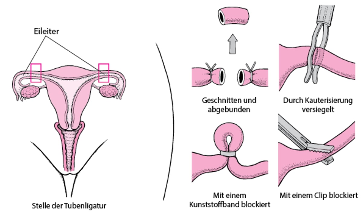 Tubensterilisation