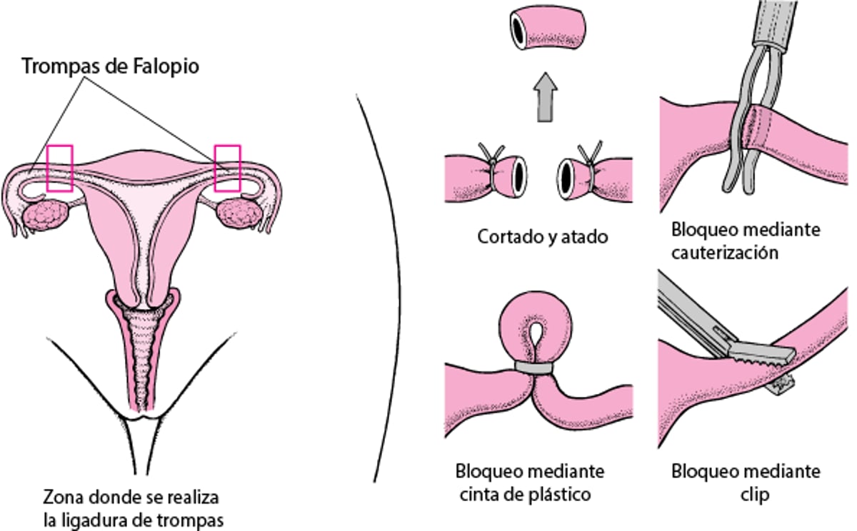Esterilización tubárica