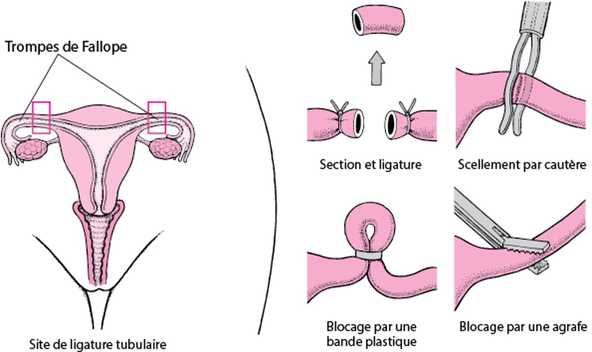 Stérilisation par ligature des trompes