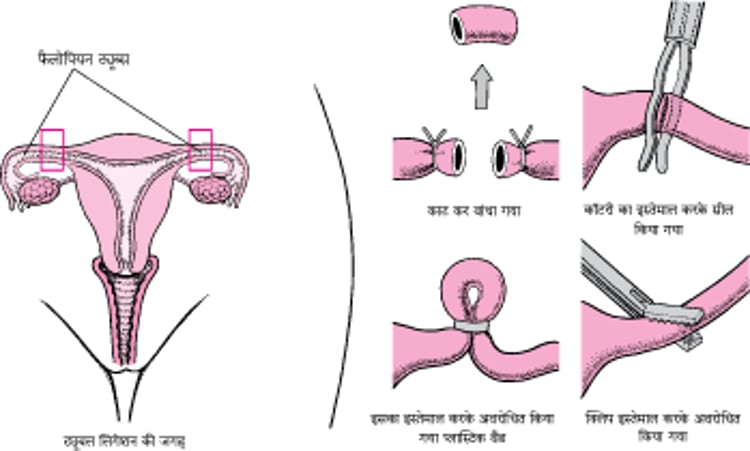 ट्यूबल स्टरलाइजेशन