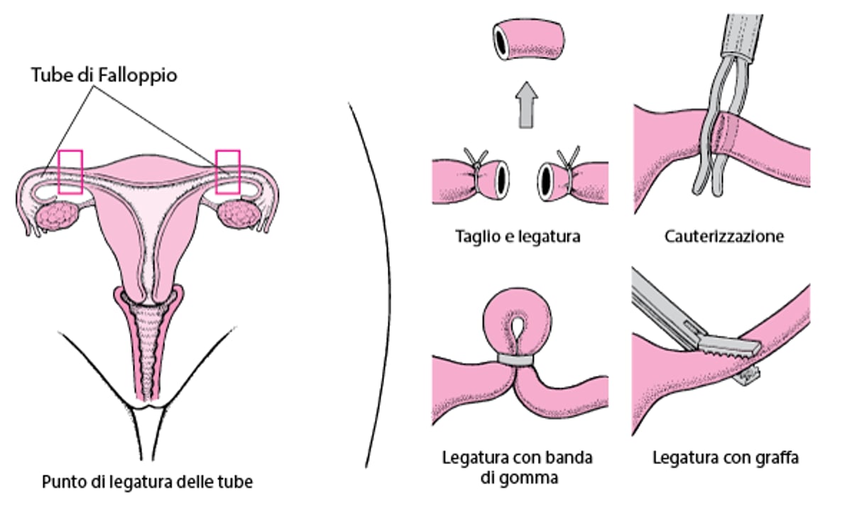 Sterilizzazione tubarica