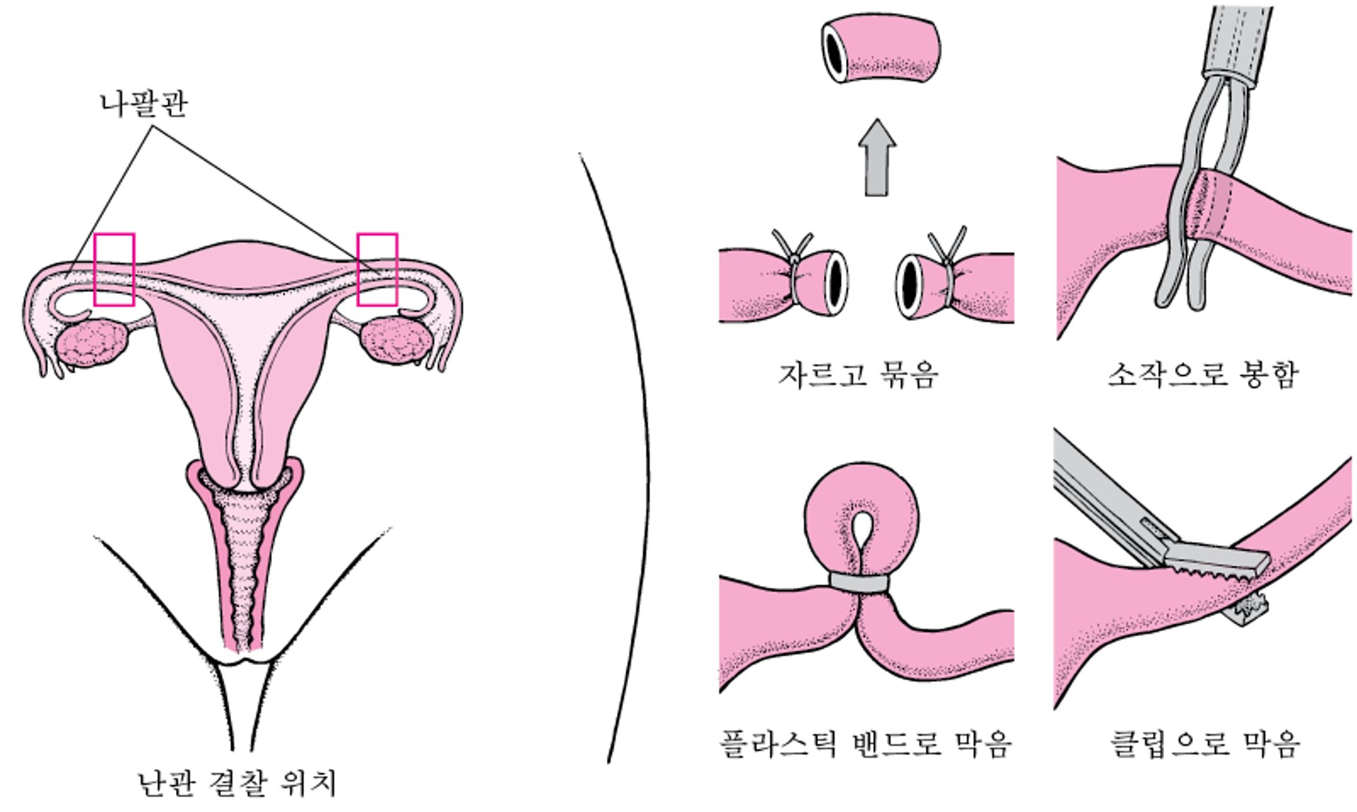 난관 불임술