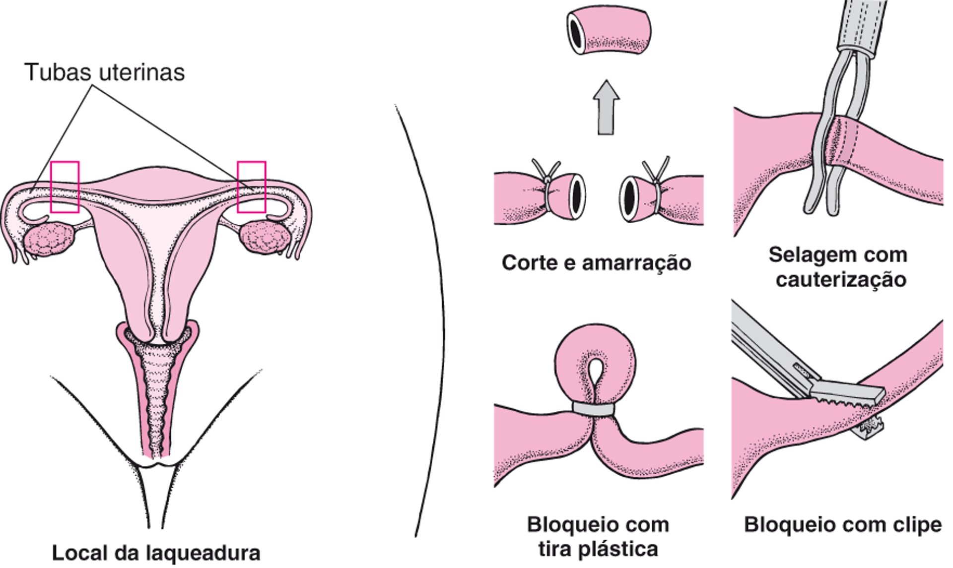 Laqueadura tubária