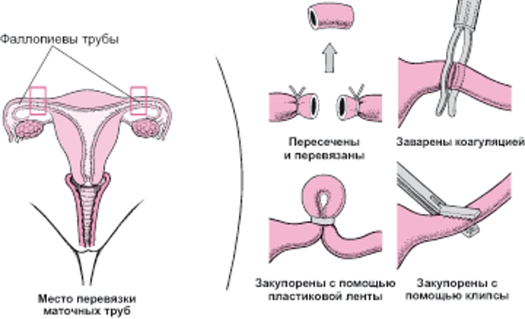 Трубная стерилизация