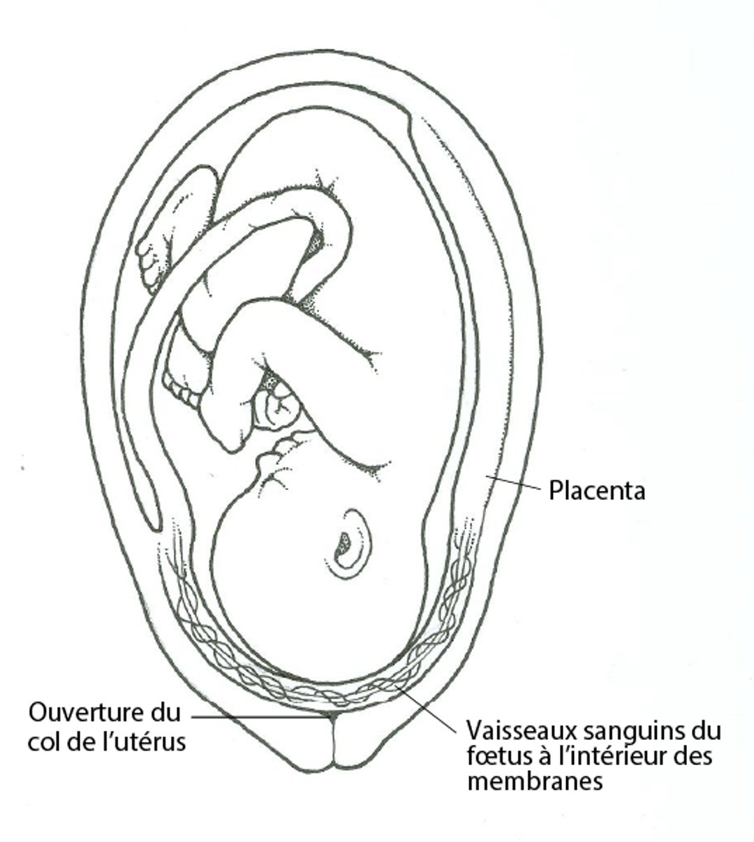 Qu’est-ce qu’un vasa prævia ?