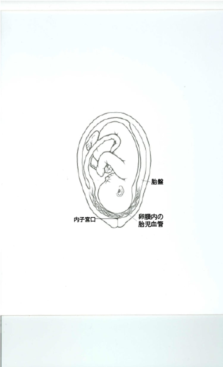 前置血管とは