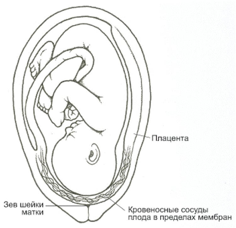 Что такое предлежание сосудов?