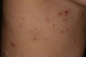 Mollusco contagioso